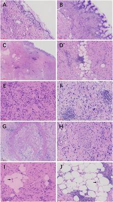 Case report: Ovarian mucinous tumor with a mural nodule of liposarcoma: a rare case